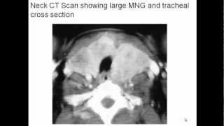 Multinodular Goiter Evaluation and Management [upl. by Rabin807]