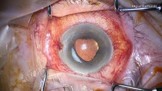 Late pseudophakic quotmalignantquot glaucoma [upl. by Hutchinson]