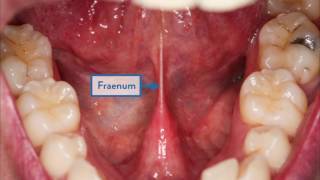 How To Check Your Mouth A Guide To Spotting Mouth Cancer [upl. by Derfniw]