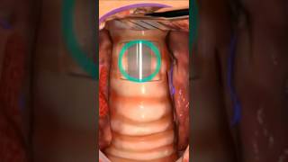 Tracheostomy SurgeryTracheostomy procedure 3D animationTracheostomy Tubeviralshortshorts feeds [upl. by Noiro]