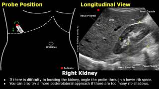 Kidney Ultrasound Probe Positioning  Transducer Placement amp Scanning  Abdominal USG  Sonography [upl. by Eetnwahs]