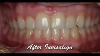 Invisalign Express with WhiteningBefore amp AfterMick Family Dental Care [upl. by Link]