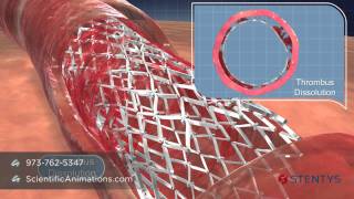 3D Medical Animation of Coronary Stent Procedure [upl. by Cooperman]