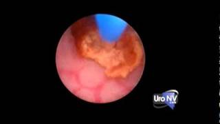 Ureteroscopy  Breaking up a kidney stone in the lower ureter [upl. by Aileme]