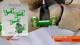 ORTHOLOC™ 3Di Foot Reconstruction System Flatfoot System Animation [upl. by Ahsikram312]