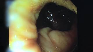 Video of a Colonoscopy [upl. by Nosreh488]