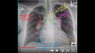 Radiology Course  Pulmonary Hypertension CXR Interpretation [upl. by Arodnahs]