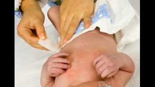 Diaper Rash 1 Symptoms types such as irritant yeast allergic [upl. by Anatole309]