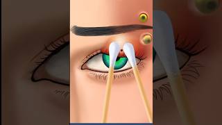 ASMR green Eye piercing swelling redness amp Mega worm treatment 2d animation [upl. by Ettelrats]