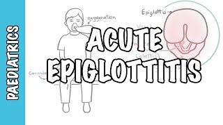 Acute Epiglottitis  signs and symptoms causes pathophysiology treatment [upl. by Nelson]