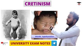 Cretinism  Hypothyroidism  Endocrine Physiology [upl. by Ahras480]