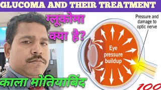 Glucoma and their Treatment in Hindi  ग्लूकोमा और इसके इलाज के बारे में संपूर्ण जानकारी [upl. by Eidnar616]