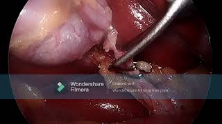 LAPAROSCOPIC CHOLESYSTECTOMY [upl. by Honeyman]