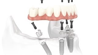 Dental Implant Osseointegration Process [upl. by Audley]