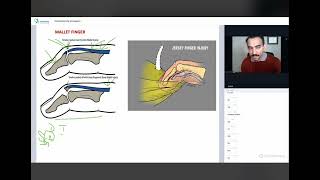 Jersey finger and Mallet Finger Short topics by Ankit Shahi for your NPTE prep NPTE StudyBuddy [upl. by Baudelaire495]