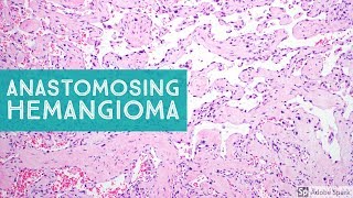 Anastomosing Hemangioma 101Explained by a Soft Tissue Pathologist [upl. by Irem]