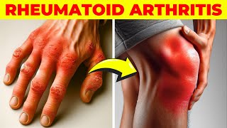 Arthritis  Symptoms Causes Types Treatment amp Prevention [upl. by Sillsby233]