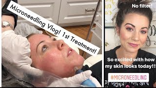 Microneedling Procedure for Acne Scars amp Textured Skin Part One [upl. by Beaufert]