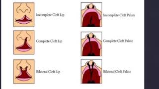 cleft lip and palate in Hindi [upl. by Nels]