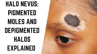 Understanding Halo Nevus Pigmented Moles and Depigmented Halos Explained skintreatment [upl. by Richy]