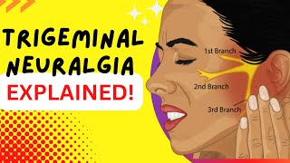 Trigeminal Neuralgia  Explained  Worlds most painful disease Causes and Treatment [upl. by Valina]