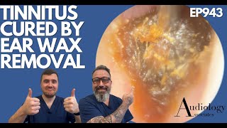 TINNITUS CURED BY EAR WAX REMOVAL  EP943 [upl. by Elam]