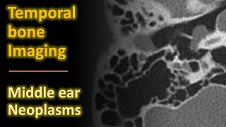 Temporal Bone Imaging  Glomus tympanicum amp other middle ear neoplasms [upl. by Merceer]