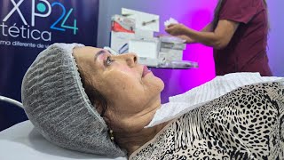 🟠Mesobotox y el MICRONEEDLING [upl. by Zingale]