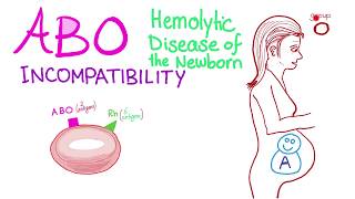 ABO Incompatibility  Hemolytic Disease Of The Newborn HDN  Hematology amp Pathology [upl. by Hirst427]