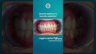 Prima e dopo  Faccette dentali [upl. by Froma]