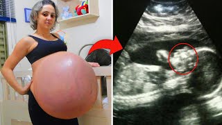 This Woman Had an Enormous Bump When She Was 12 Weeks Pregnant Then It Just Kept on Growing [upl. by Aicileb]