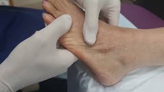 Ganglion Cyst Drainage Compilation [upl. by Reinar450]