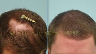 Dallas Hair Transplant for Scarring Alopecia LPP [upl. by Chard477]