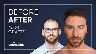 Hair Transplant in Turkey  Results  Dr Acar  Cosmedica Clinic [upl. by Ellehcor]