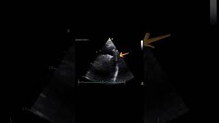 ⚠️COARTACIÓN AÓRTICA Caso ECOCARDIOGRAMA [upl. by Shannah]