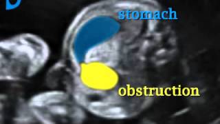 Fetal Medicine Foundation  Duodenal stenosis [upl. by Engedus207]