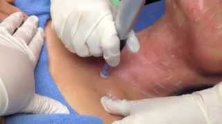 Dermapen video explaining procedure and showing procedure done [upl. by Russom955]