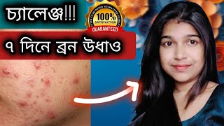 চ্যালেঞ্জ😱 জীবনে আর কখনো ব্রন হবে না  Pimples Removal On Face At Home  pimplesremoval [upl. by Thetisa383]