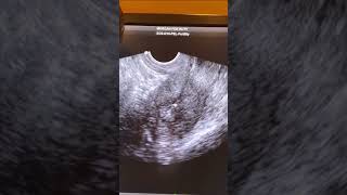 How Does an EMBRYO TRANSFER Work Live EmbryoTransfer Demo [upl. by Pembrook]