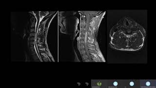 Neoplasias Intramedulares primera parte [upl. by Davin15]