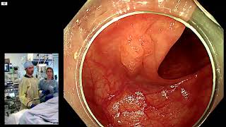 Characterization and resection of a recurrence of a SSL sessile serrated lesion in the colon [upl. by Erdnaid]