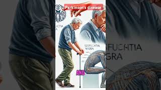 Parkinsons disease definition symptoms etiology management [upl. by Enidlareg]