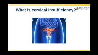 Treatment of Cervical Insufficiency [upl. by Ettevets]