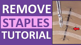 Surgical Staple Removal Nursing  How to Remove Surgical Staples [upl. by Allianora]