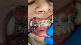 dental ortho treatment [upl. by Anat]