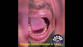 TONGUE FASCICULATIONS [upl. by Areema]