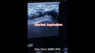 Knee joint ultrasound Guided effusion Aspiration [upl. by Adnat]