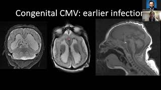 Congenital and Perinatal CNS Infections  Dr Yi Li  5162024 [upl. by Etac]