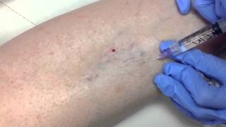 Sclerotherapy [upl. by Acitel921]