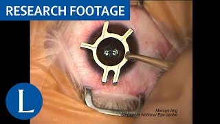 Surgical video Femtosecond LASIK procedure Video 1 of 2 [upl. by Gesner]